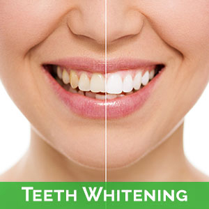 Teeth Whitening in Brentwood