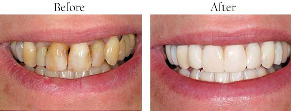 Before and After Teeth Whitening in Brentwood
