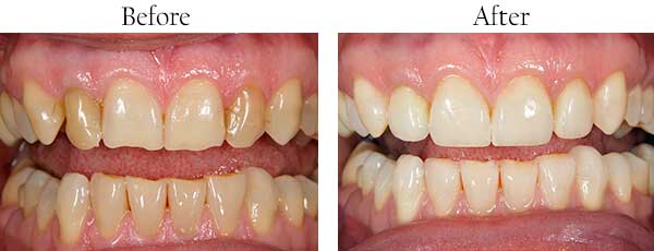 Before and After Invisalign in Brentwood
