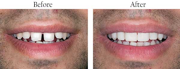 Before and After Dental Implants in Brentwood