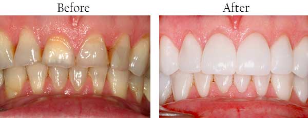 Brentwood Before and After Dental Implants