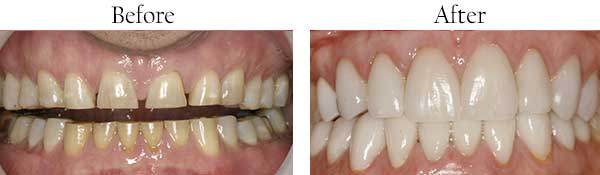Before and After invisible Braces in Brentwood