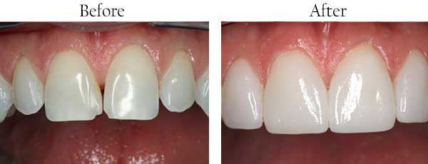 Before and After Dental Bleaching in Brentwood